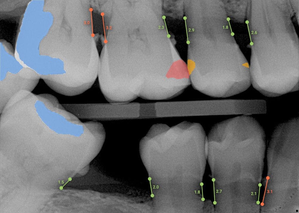 Overjet’s AI for Dental X-rays Helps Elevate Patient Care