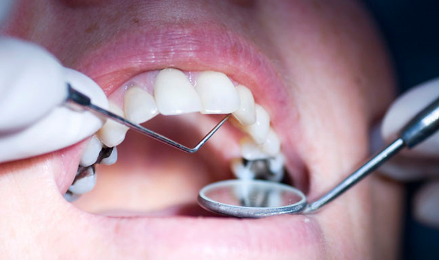 Study finds watching cement dry could increase dental filling success