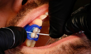 Flossing restored teeth