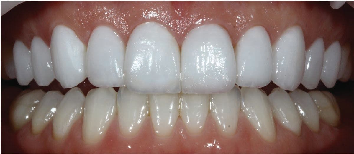 Create Beautiful Temporaries That Last With This Natural-Looking Material | Image Credit: © Jennifer Derse, DDS