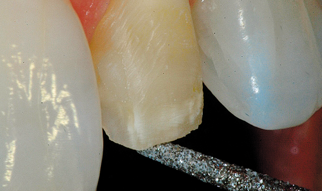 Adjacent tooth structure lowered