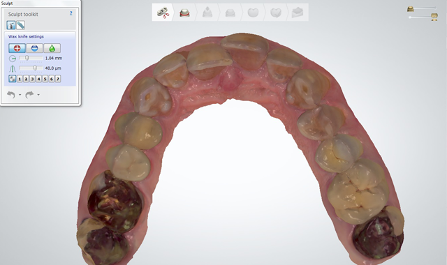 Preoperative occlusal view of the maxillary arch digital scan