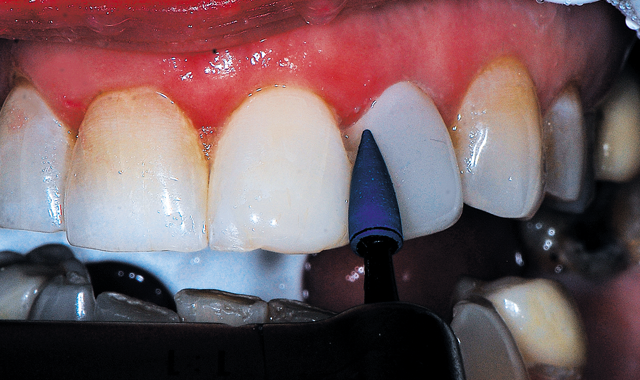 A blue ultrafine grit diamond finishing point (Couture, Centrix Dental) used with light pressure in an electric slow-speed handpiece with water, polishing the gingival third of the restoration.