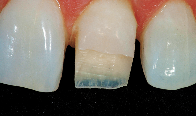 Remaining tooth structure removed around depth cuts