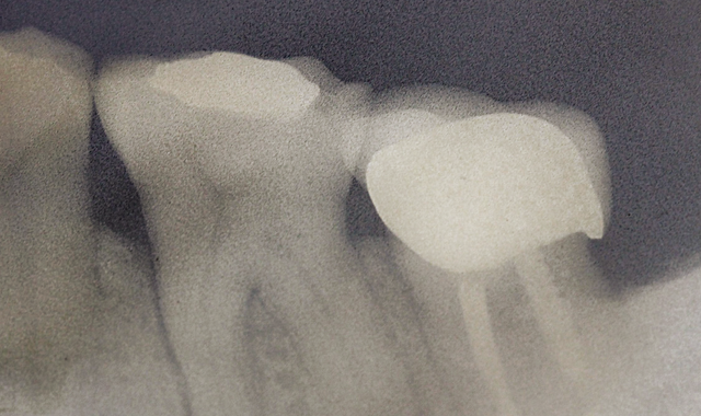 X-ray of tooth demonstrating lesion around mesial root. 