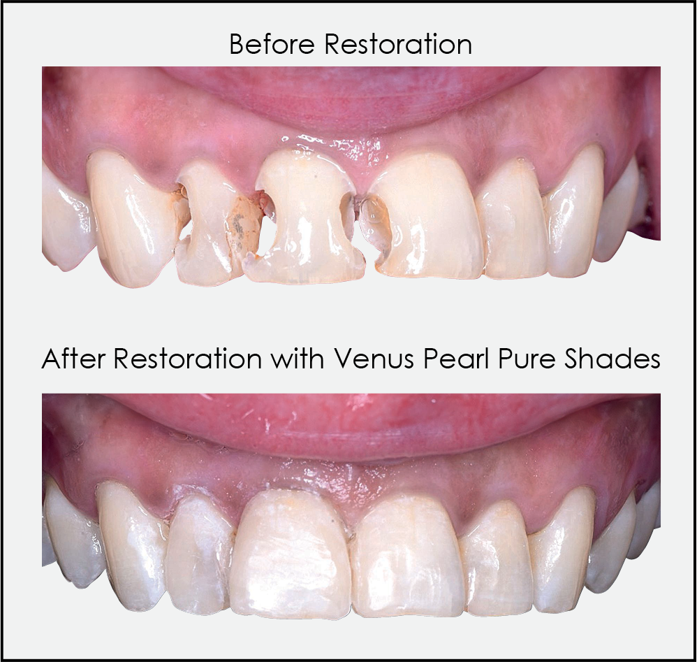 New Venus Pearl Pure Shades Formulated to Simplify Dental Restorations  | Image Credit: © Kulzer North America
