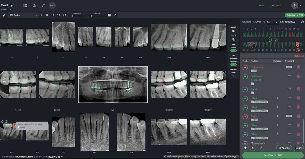 Denti.AI Revolutionizes Pathology Detection with FDA Clearance for Denti.AI Detect | Image Credit: © Denti.AI 