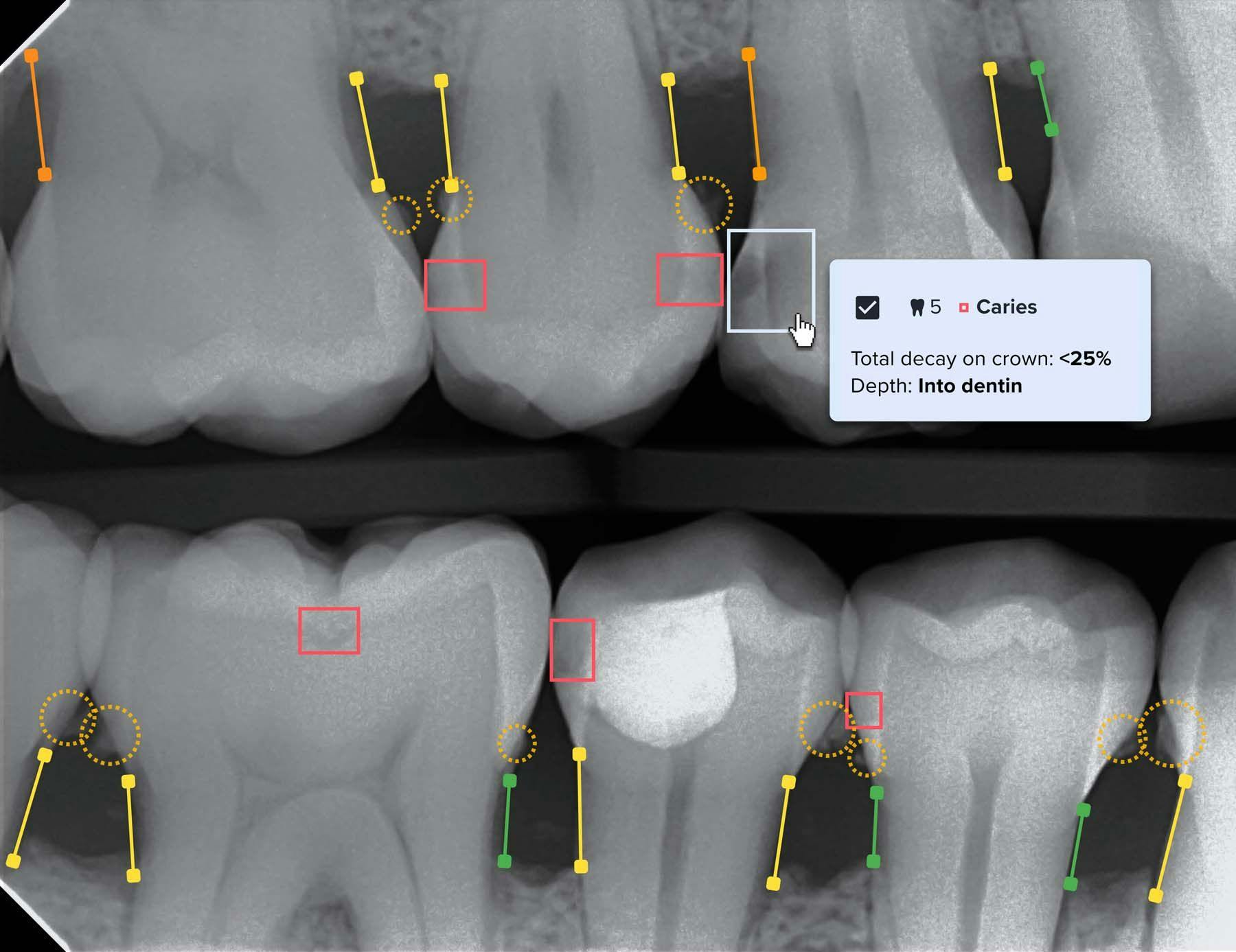 Videa Dental Assist uses AI technology to assist clinicians in diagnosing x-rays and in recommending treatment plans for patients. | Image Credit: © VideaHealth