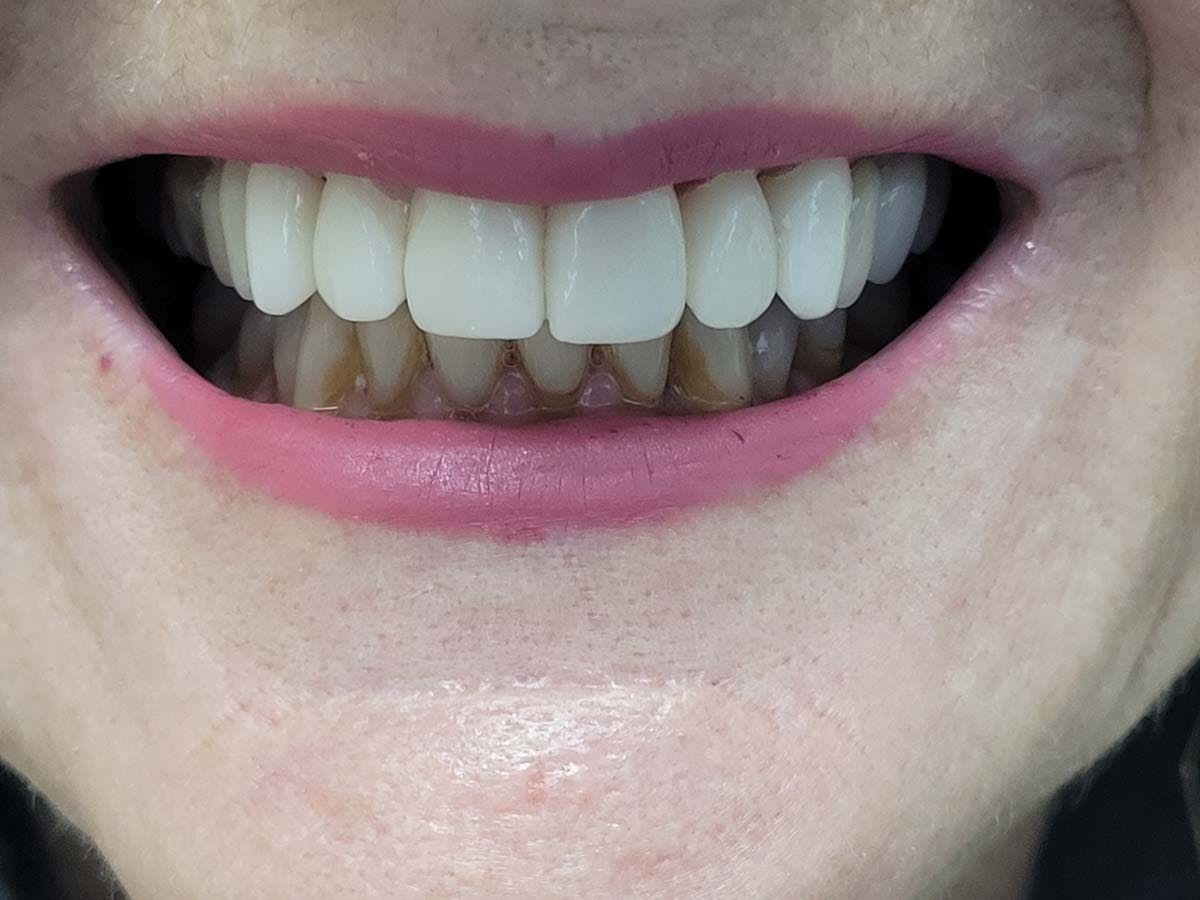 How to Revitalize Smiles With Advanced Zirconia Veneers. Image credit: © Linda Pearce, DDS