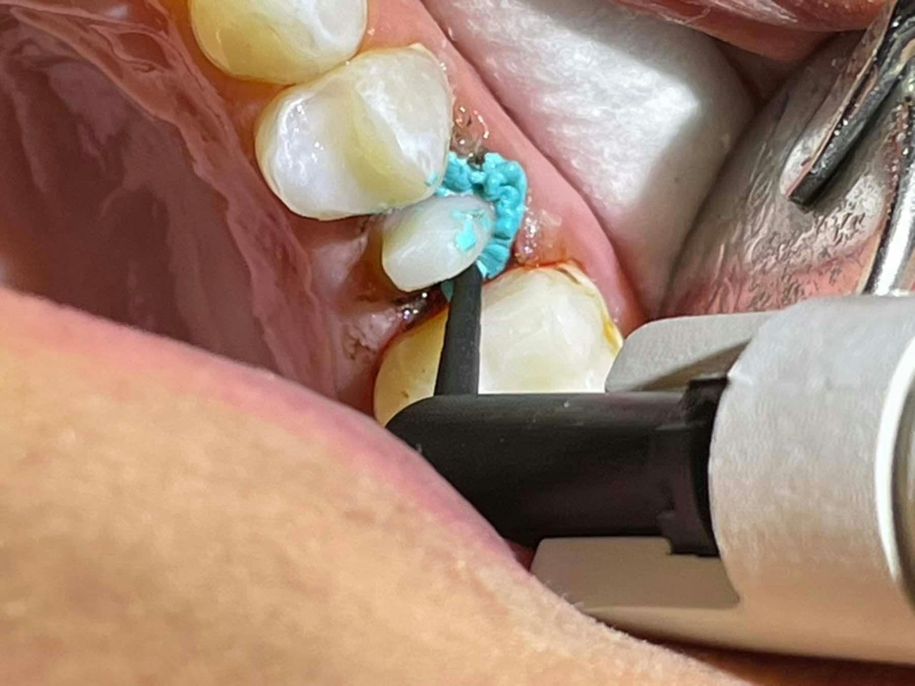 Why This Retraction Paste Is So Special | Image Credit: © Ankur Gupta, DDS