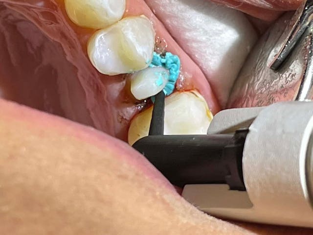 Why This Retraction Paste Is So Special | Image Credit: © Ankur Gupta, DDS