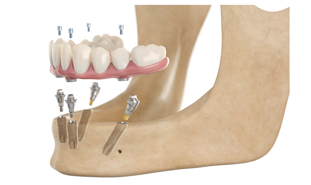 Dentsply Sirona Implants to present several new solutions to their portfolio at IDS