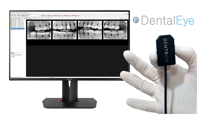 Dentron Systems acquires exclusive rights to DentalEye software