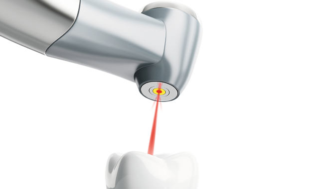 Choosing the right dental laser for your practice