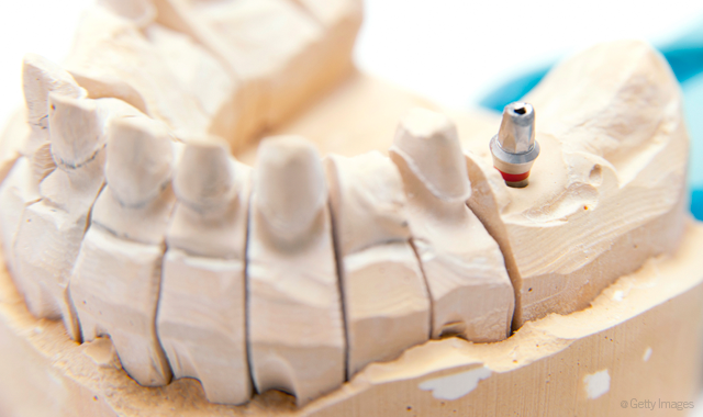 New discovery can prevent dental implant infections