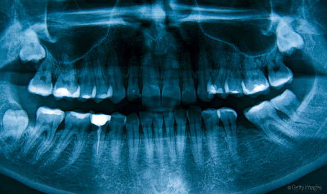 Study finds material that could make stronger dental fillings