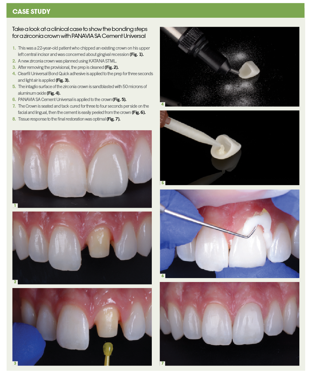 Case Study and clinical images courtesy of Sergio Arias, DDS, MS, Prosthodontist.