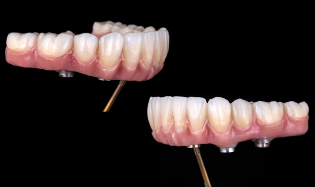 Final zirconia restoration from lateral view