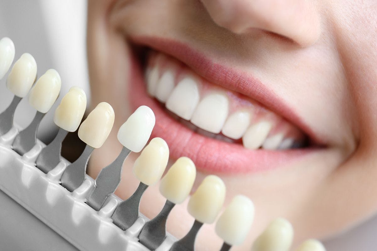 Rewards programs that include whitening products can help practices attract new patients and increase treatment acceptance. | Image Credit: © AFRICA STUDIO / STOCK.ADOBE.COM
