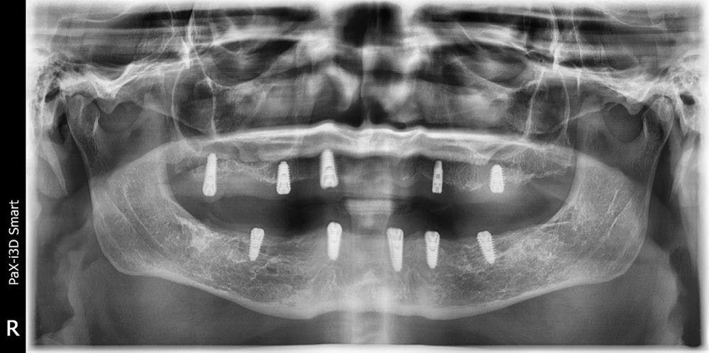 Looking back at this x-ray, Dr Gupta was not happy that almost every implant in the maxilla has threads showing above the bony crest (Figure 2).