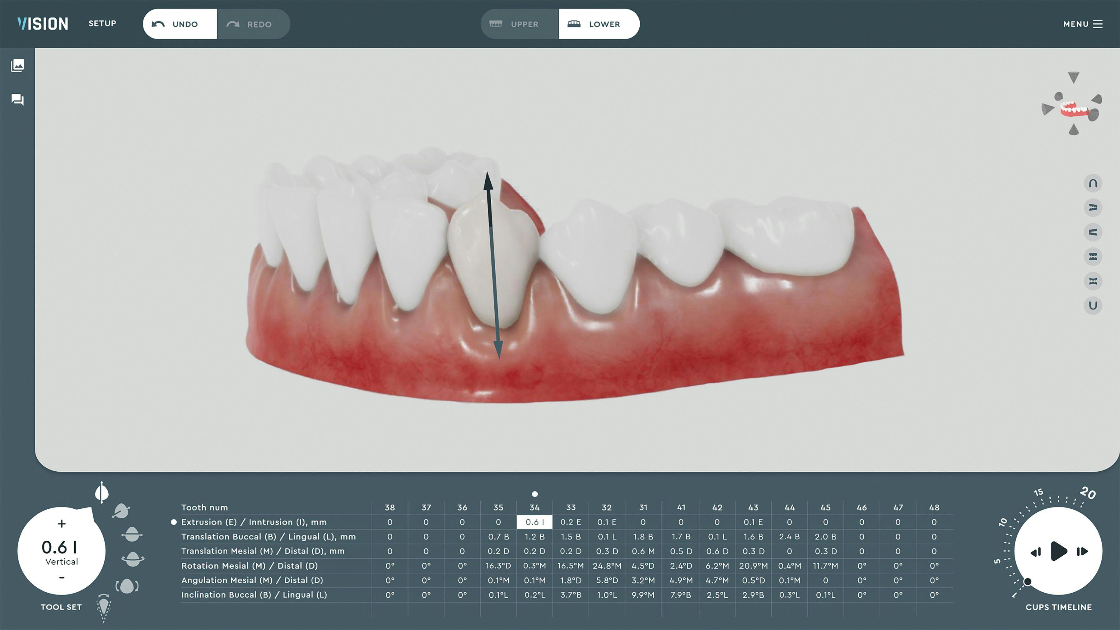 Solve My Problem: Aligner software that uses biomechanics and machine-learning