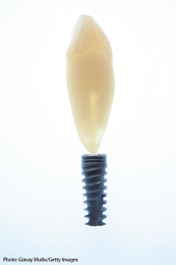 Implants have come a long way, and innovation continues to revolutionize what can be done. 