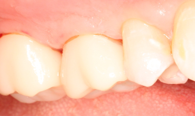 How to streamline the cementation of crowns