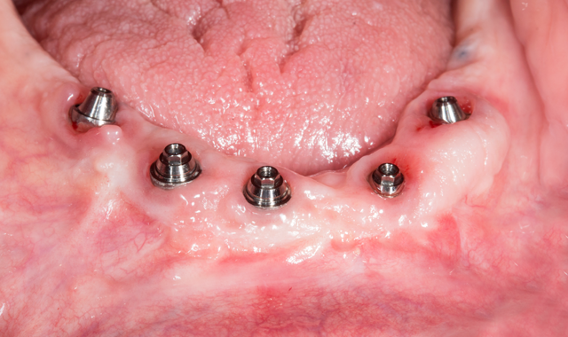 Multi-unit abutments in place
