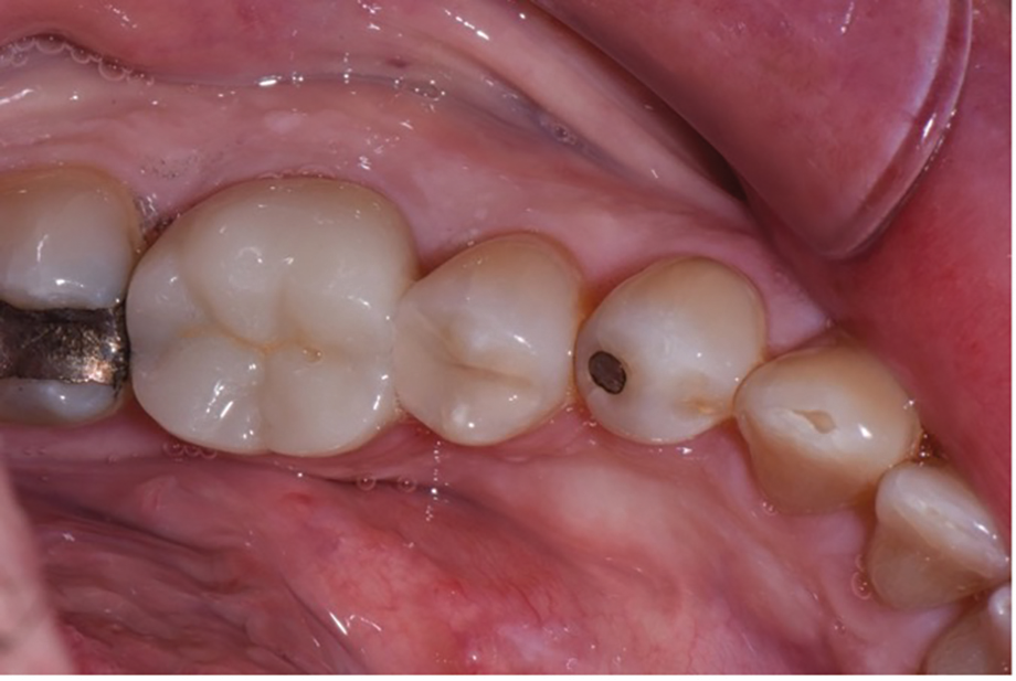 The postop view showing the single shade composite blending in with surrounding tooth structure.