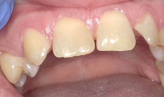 How to go beyond conventional composites in restorative dentistry