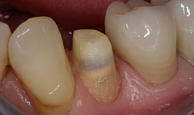 How and why to use ACTIVA BioACTIVE-CEMENT for crown cementation