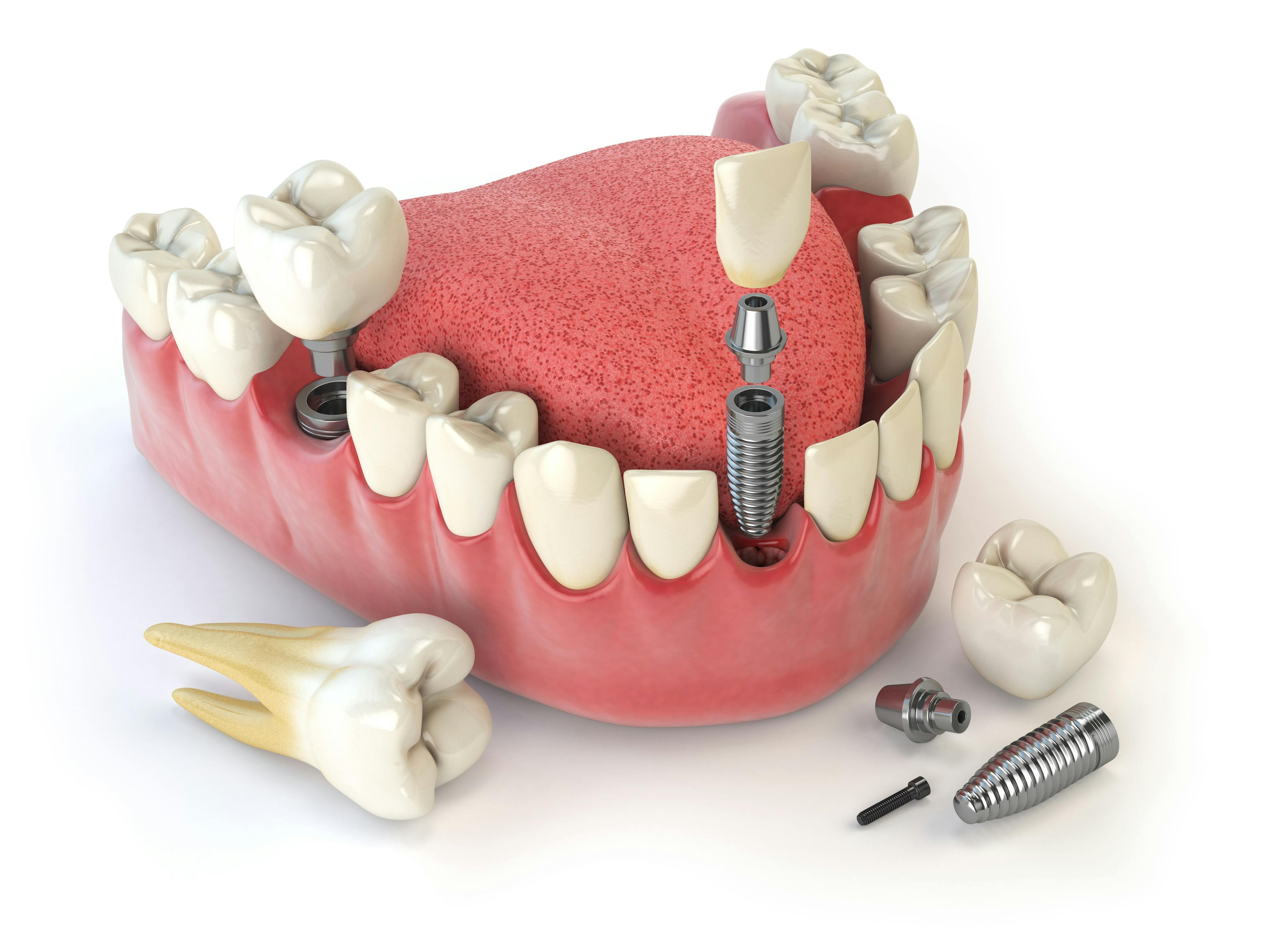 Dental implants - Maksym Yemelyanov / stock.adobe.com