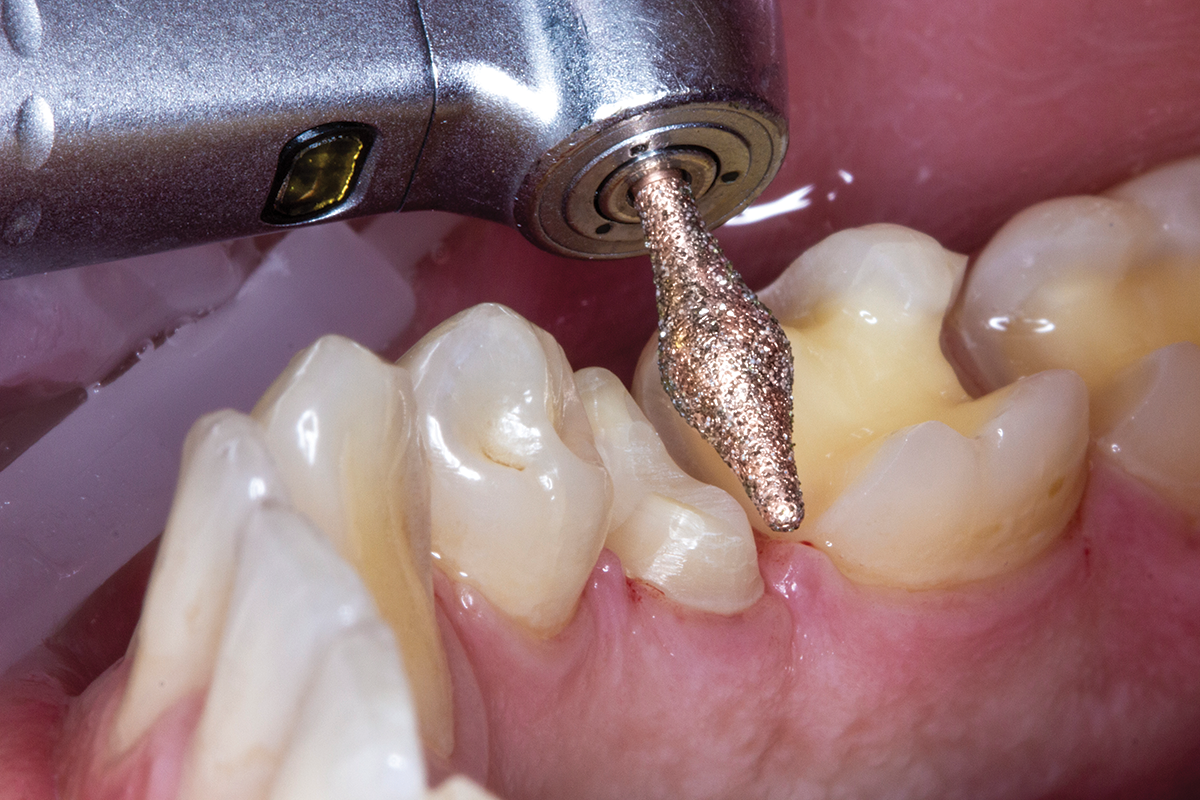 Komet’s DIAO Is a True Breakthrough In Dental Bur Design