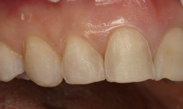 How to prevent subgingival margins by the use of a new resin temporary cement