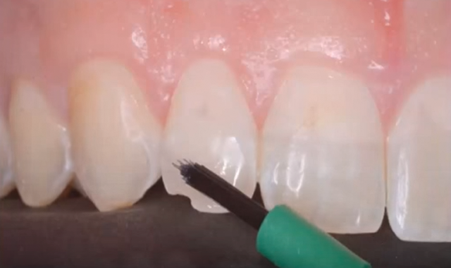 Using SDI’s Aura to complete an anterior restoration [VIDEO]