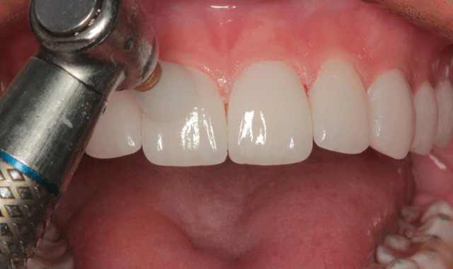 How to place porcelain veneers with minimal preparation
