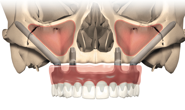 New NobelZygoma implants an excellent option for treating severe maxillary resorption without bone grafts