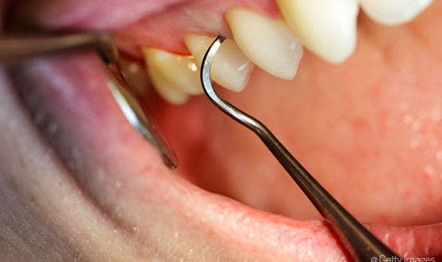 New study finds periodontal disease most prevalent among ethnic minorities