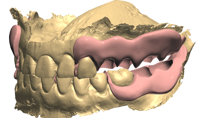 Tooth pocketing is performed on the denture base 