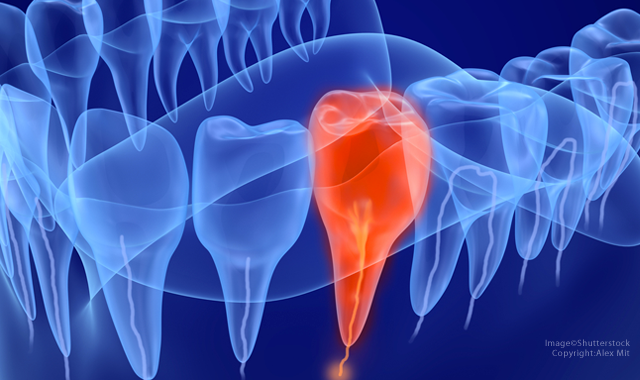 Can root canal treatment be improved with prefabricated blood vessels?
