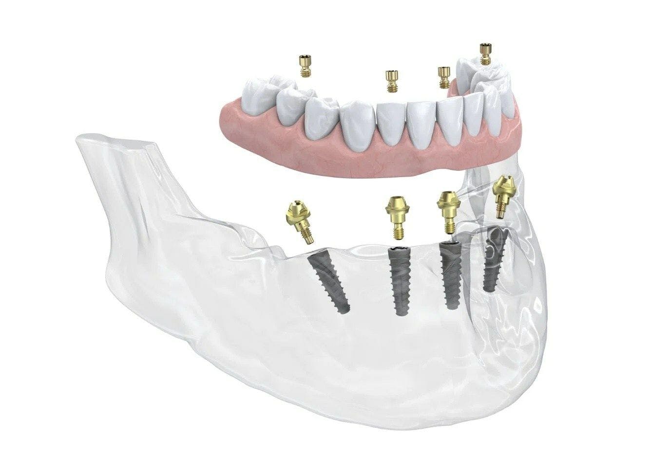 New Multi-Unit Abutment Available for the Neoss4+ Treatment Solution from Neoss Group | Image © Neoss Group