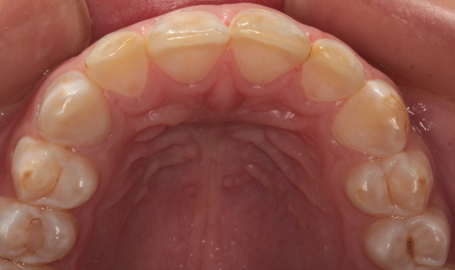 Incisal view before treatment