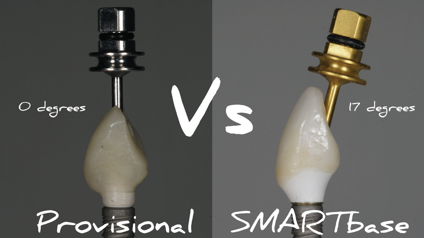 SMARTbase Abutment, a Game Changer in Dental Implant Restorative Solutions