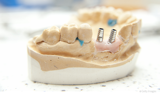 Study finds microthreaded dental implants may preserve crestal bone