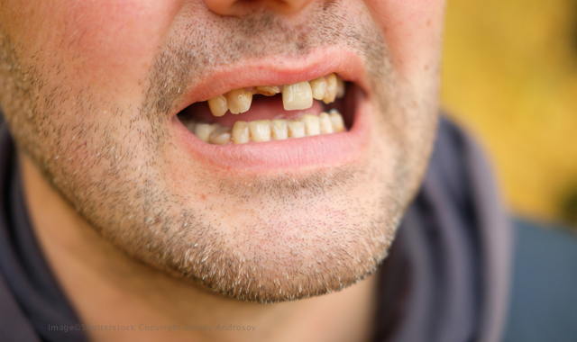 Can tooth loss lead to cardiovascular disease?