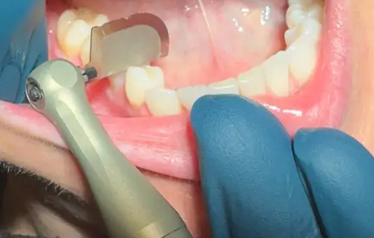 Dentatus Profin Reciprocating System in use for interproximal reduction