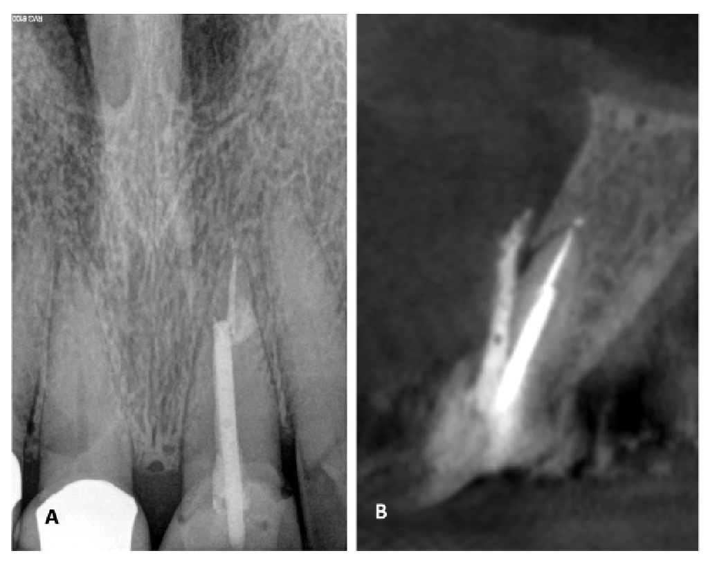 Figure 3. Teeth with preexisting perforations have a poor expected prognosis for nonsurgical or surgical retreatment. This patient presented with severe palpation tenderness and an associated 7-mm periodontal probing depth on the facial aspect of tooth #8. Although the periapical radiograph (A) appeared largely normal, the sagittal view on cone beam computed tomography (CBCT; B) revealed restorative material extruded through a perforation. Extraction was recommended.