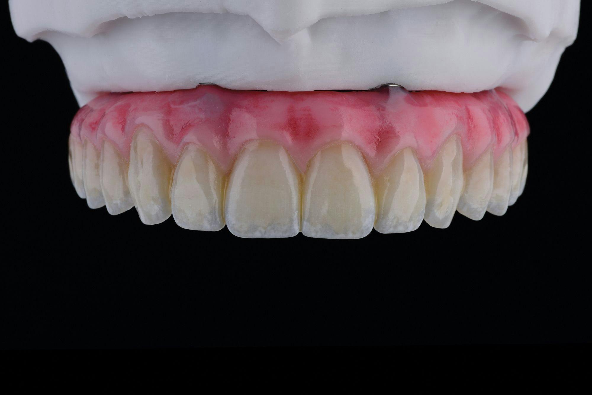3D-Printed Denture Material Showcases Strength and Esthetics