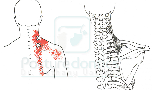 How to treat pain caused by trigger points