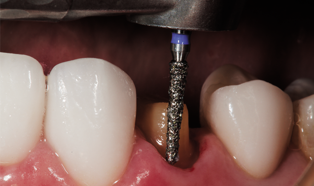 How to perform rapid tooth reduction with diamond instruments